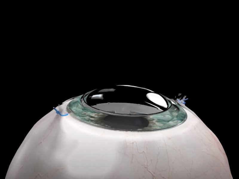 Kornea sintetis ini bisa kembalikan mata orang yang buta