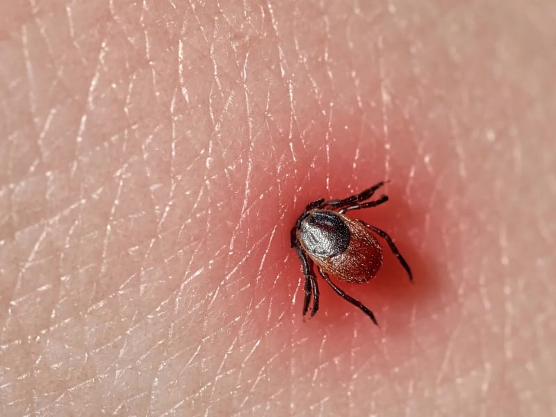 3 fakta mengenai protein dalam keringat manusia berpotensi melawan penyakit Lyme yang ditularkan oleh kutu